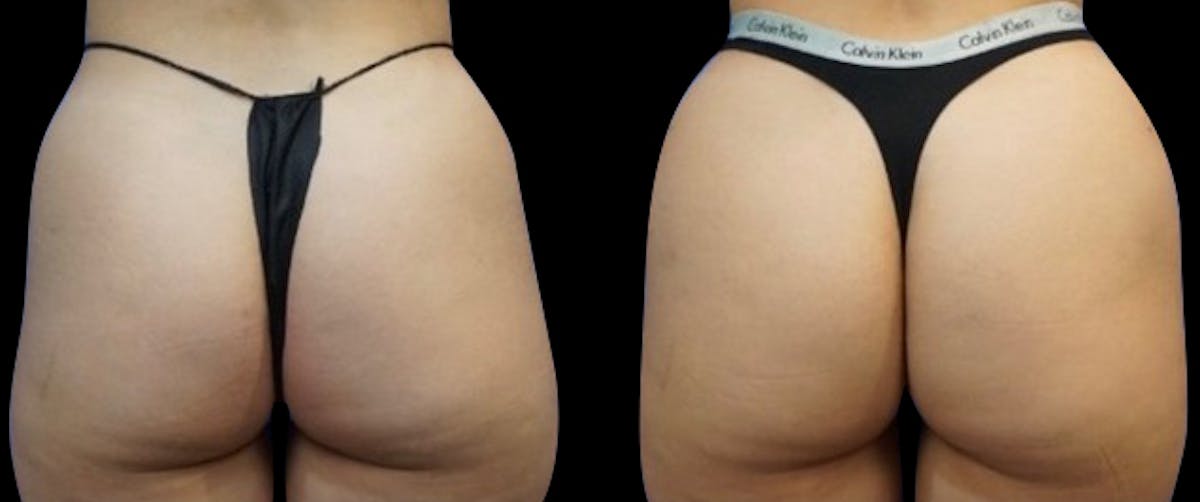 alloClae™ Adipose Filler Before & After Gallery - Patient 261564 - Image 1