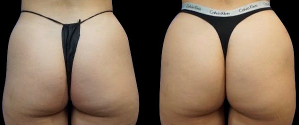 alloClae™ Adipose Filler Before & After Gallery - Patient 261564 - Image 1