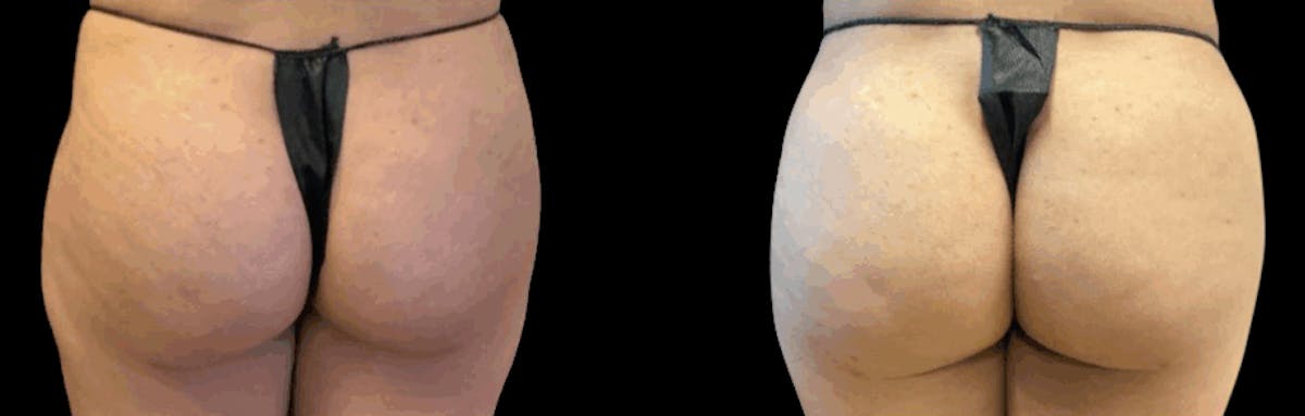 alloClae™ Adipose Filler Before & After Gallery - Patient 425952 - Image 1