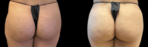 alloClae™ Adipose Filler Before & After Gallery - Patient 425952 - Image 1