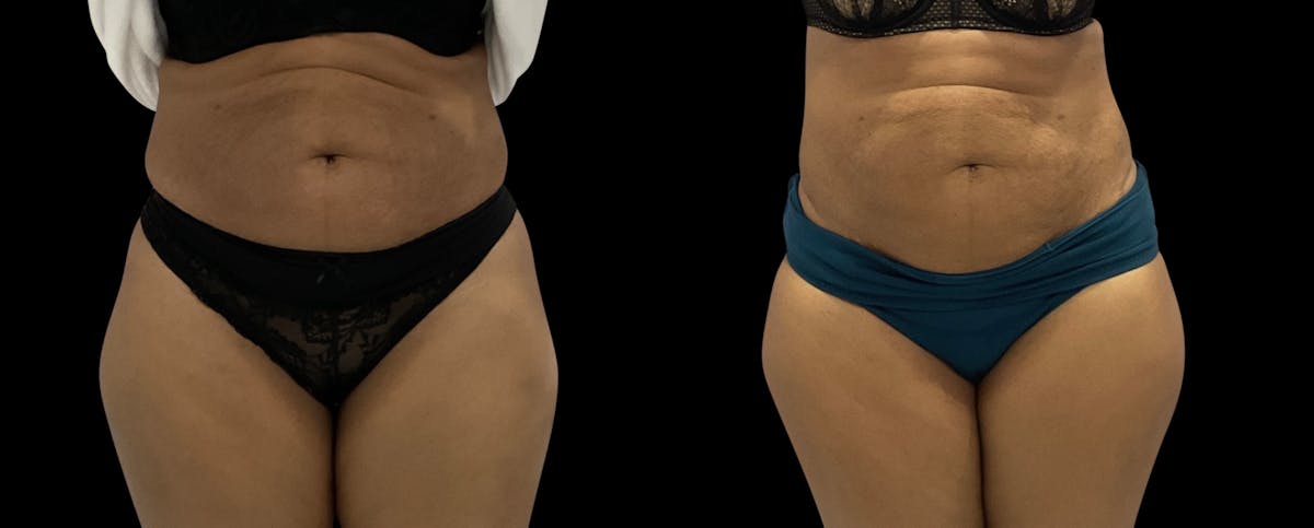 Non-Invasive Laser Lipo Before & After Gallery - Patient 263991 - Image 2