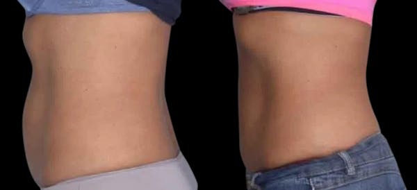 Non-Invasive Laser Lipo Before & After Gallery - Patient 219862 - Image 1