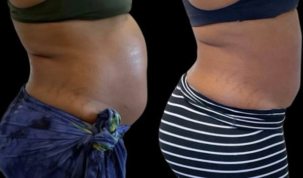 Non-Invasive Laser Lipo Before & After Gallery - Patient 978669 - Image 1