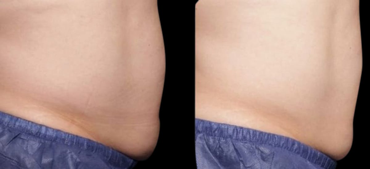 Non-Invasive Laser Lipo Before & After Gallery - Patient 331579 - Image 1