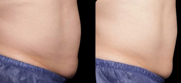 Non-Invasive Laser Lipo Before & After Gallery - Patient 331579 - Image 1
