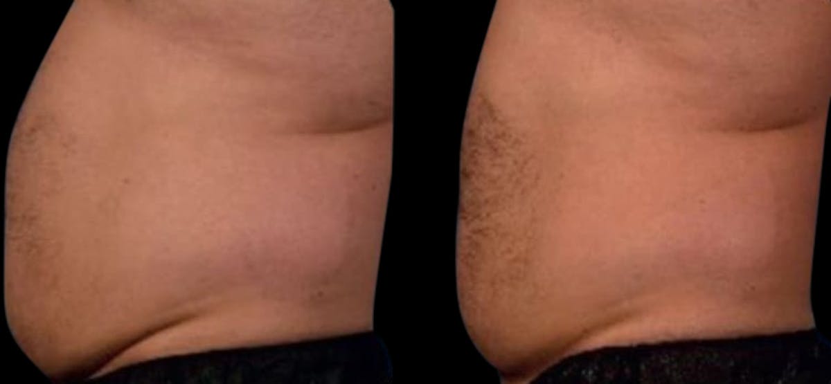 Non-Invasive Laser Lipo Before & After Gallery - Patient 140164 - Image 1