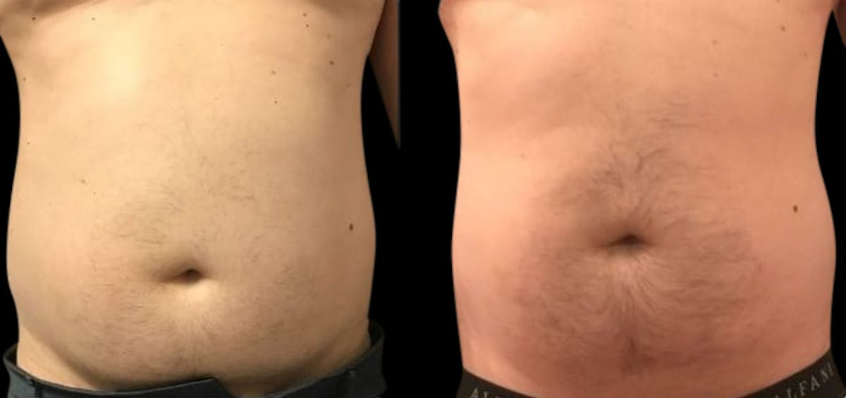 Non-Invasive Laser Lipo Before & After Gallery - Patient 342036 - Image 1