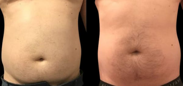 Non-Invasive Laser Lipo Before & After Gallery - Patient 342036 - Image 1