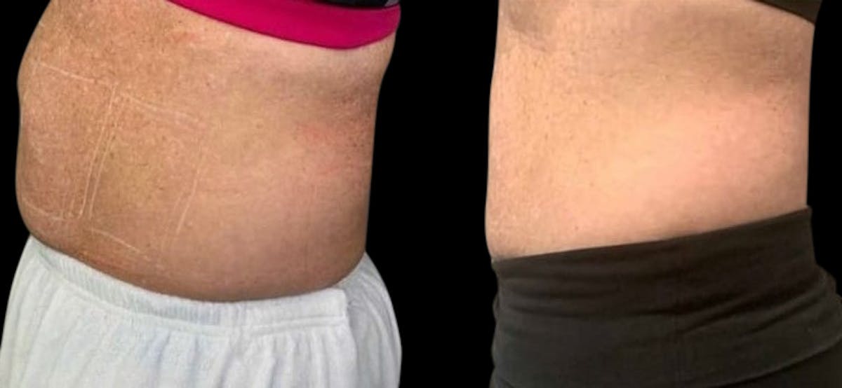 Non-Invasive Laser Lipo Before & After Gallery - Patient 372386 - Image 2