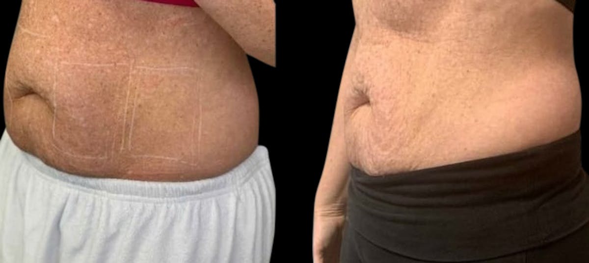 Laser Lipo