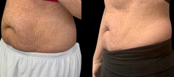 Non-Invasive Laser Lipo Before & After Gallery - Patient 372386 - Image 1