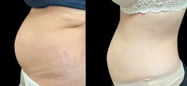 Non-Invasive Laser Lipo Before & After Gallery - Patient 178942 - Image 1
