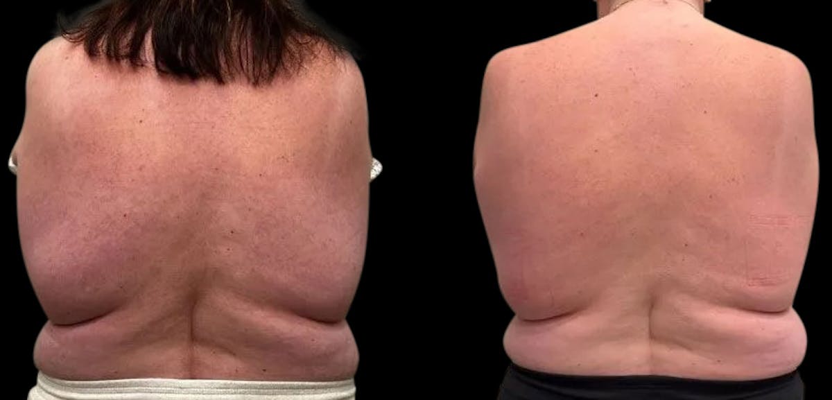 Non-Invasive Laser Lipo Before & After Gallery - Patient 263283 - Image 1