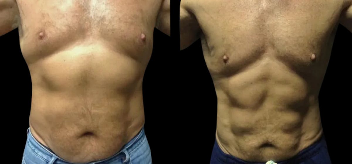 Laser Lipo