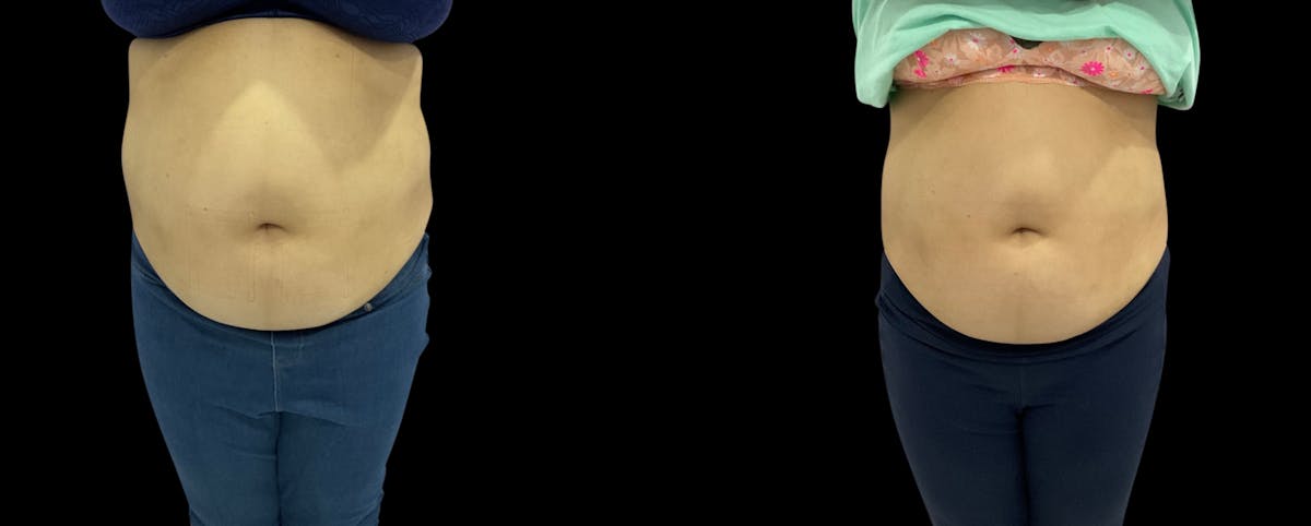 Non-Invasive Laser Lipo Before & After Gallery - Patient 261164 - Image 2