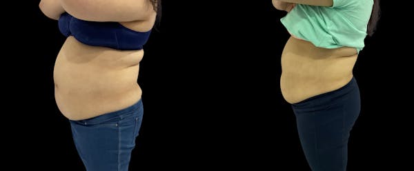Non-Invasive Laser Lipo Before & After Gallery - Patient 261164 - Image 1