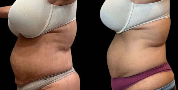 Non-Invasive Laser Lipo Before & After Gallery - Patient 355179 - Image 1
