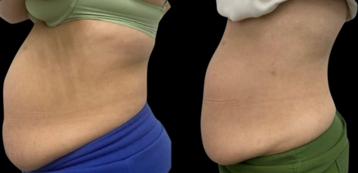 Non-Invasive Laser Lipo Before & After Gallery - Patient 267870 - Image 1