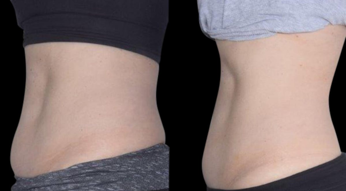 Non-Invasive Laser Lipo Before & After Gallery - Patient 322135 - Image 1