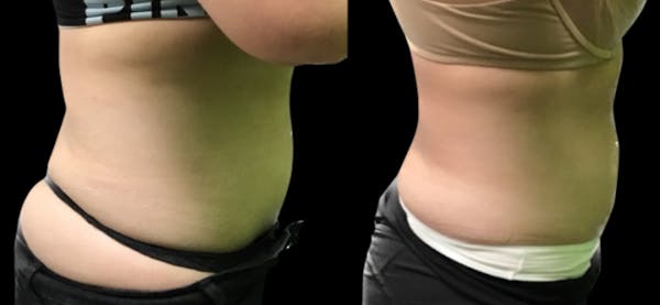 Non-Invasive Laser Lipo Before & After Gallery - Patient 565441 - Image 1