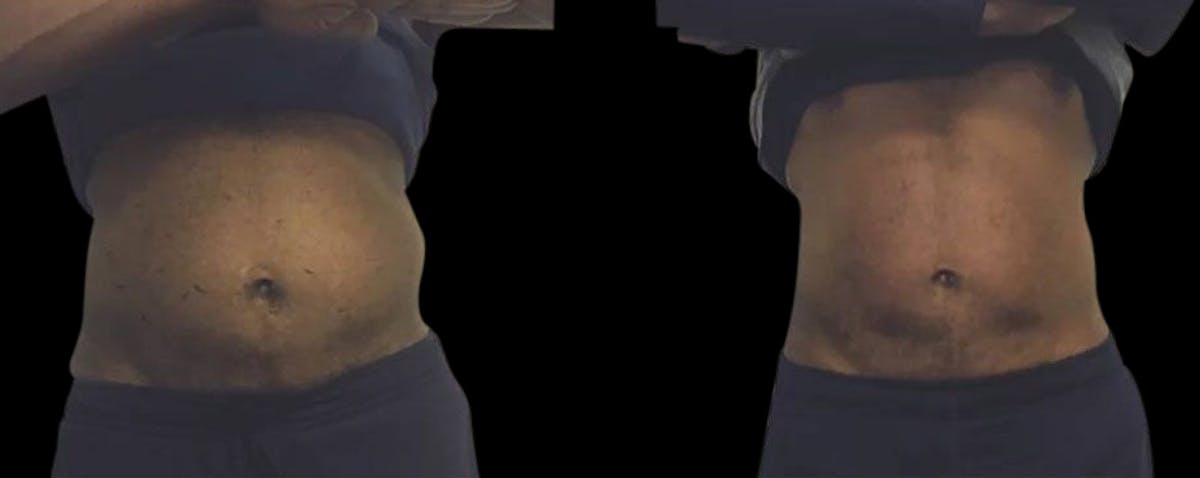 Non-Invasive Laser Lipo Before & After Gallery - Patient 122387 - Image 2