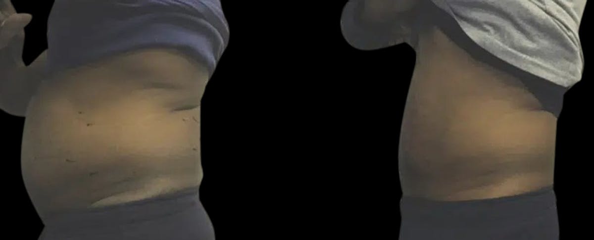 Non-Invasive Laser Lipo Before & After Gallery - Patient 122387 - Image 1