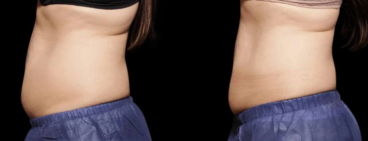 Non-Invasive Laser Lipo Before & After Gallery - Patient 902455 - Image 1