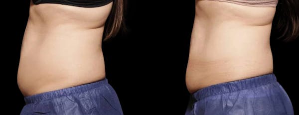 Non-Invasive Laser Lipo Before & After Gallery - Patient 902455 - Image 1
