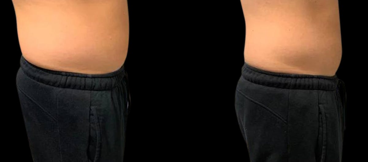 Non-Invasive Laser Lipo Before & After Gallery - Patient 233066 - Image 1