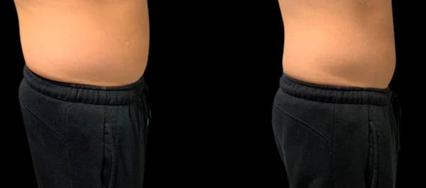 Non-Invasive Laser Lipo Before & After Gallery - Patient 233066 - Image 1