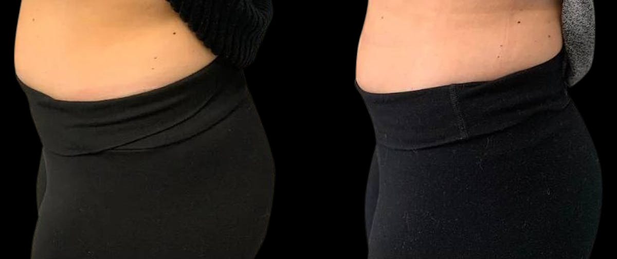 Non-Invasive Laser Lipo Before & After Gallery - Patient 402622 - Image 1