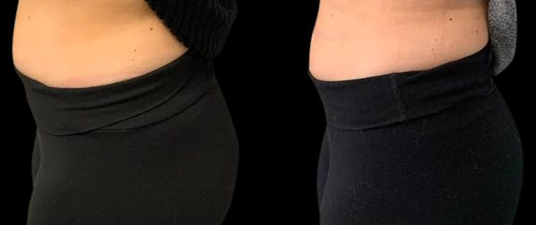 Non-Invasive Laser Lipo Before & After Gallery - Patient 402622 - Image 1