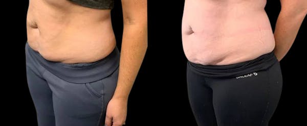 Non-Invasive Laser Lipo Before & After Gallery - Patient 150756 - Image 1