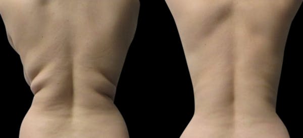 Non-Invasive Laser Lipo Before & After Gallery - Patient 147421 - Image 1