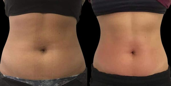 Non-Invasive Laser Lipo Before & After Gallery - Patient 433278 - Image 1