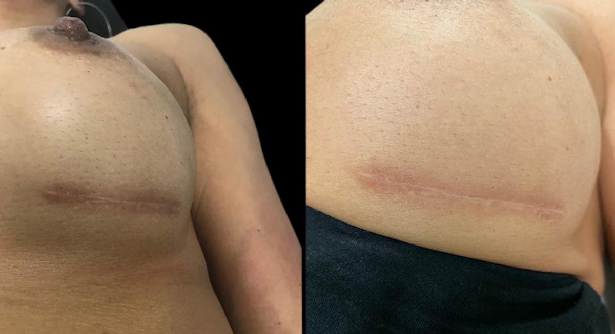 Intimate Skin Lightening Before & After Gallery - Patient 153410 - Image 1