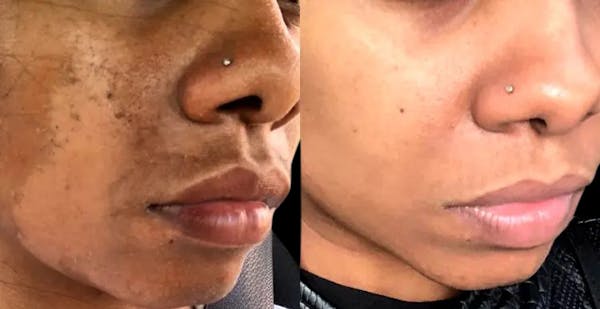 Intimate Skin Lightening Before & After Gallery - Patient 293025 - Image 1