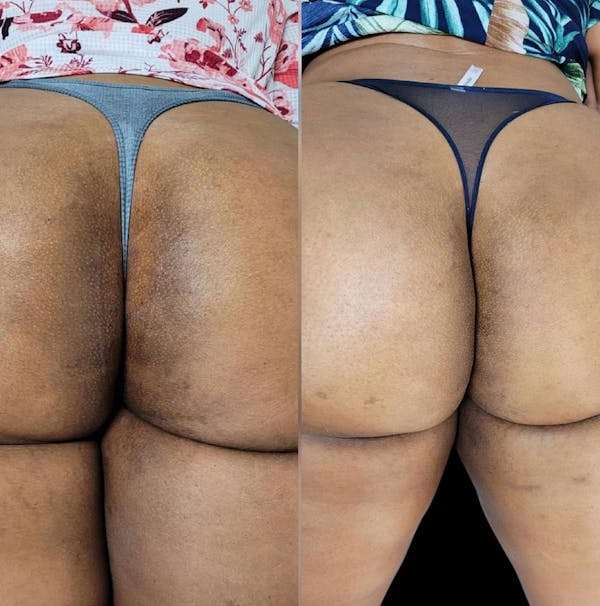 Intimate Skin Lightening Before & After Gallery - Patient 130915 - Image 1