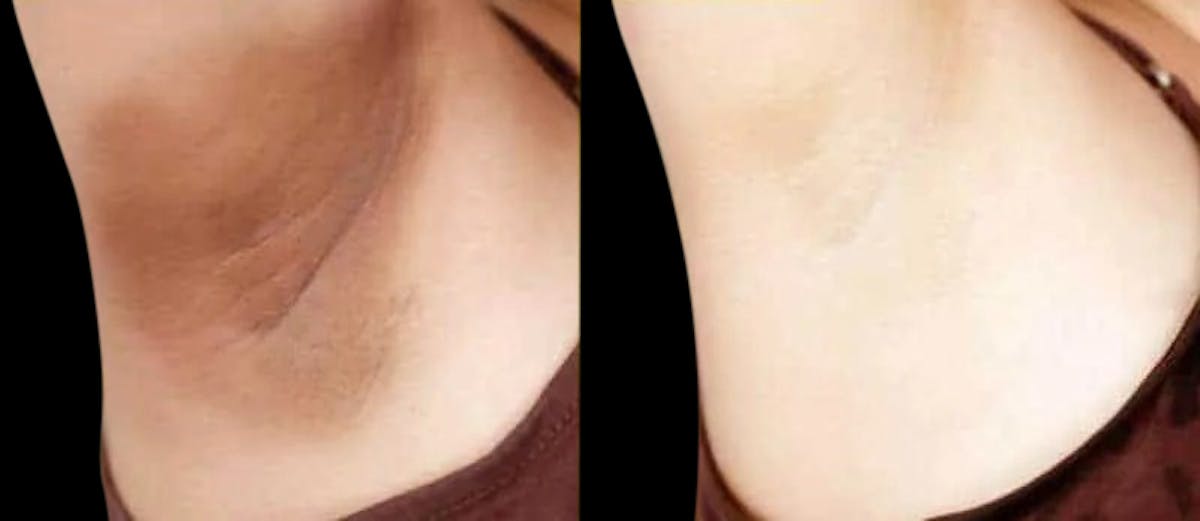 Intimate Skin Lightening Before & After Gallery - Patient 129657 - Image 1