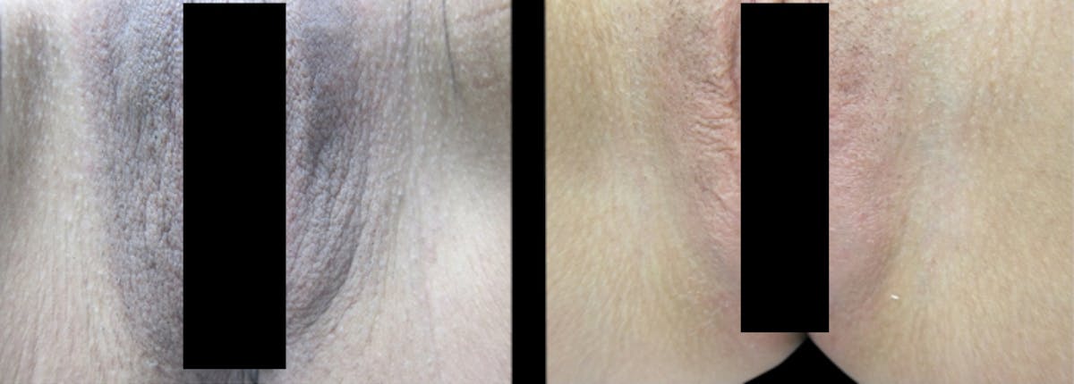 Intimate Skin Lightening Before & After Gallery - Patient 213258 - Image 1
