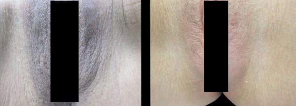 Intimate Skin Lightening Before & After Gallery - Patient 213258 - Image 1