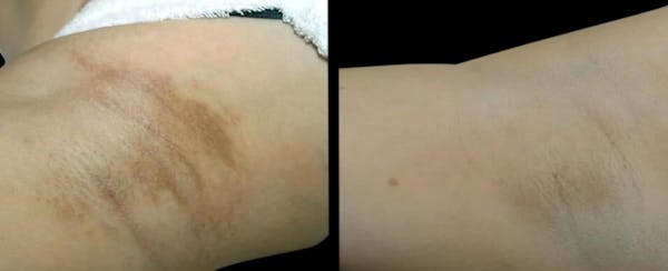 Intimate Skin Lightening Before & After Gallery - Patient 275136 - Image 1