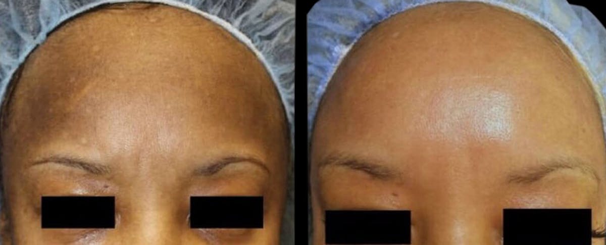 Intimate Skin Lightening Before & After Gallery - Patient 399399 - Image 1