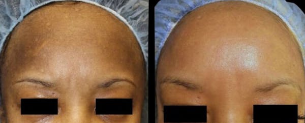 Intimate Skin Lightening Before & After Gallery - Patient 399399 - Image 1