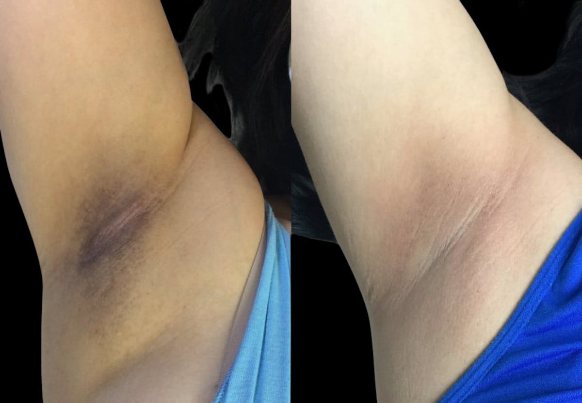Intimate Skin Lightening Before & After Gallery - Patient 292074 - Image 1