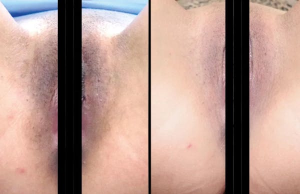 Intimate Skin Lightening Before & After Gallery - Patient 318467 - Image 1
