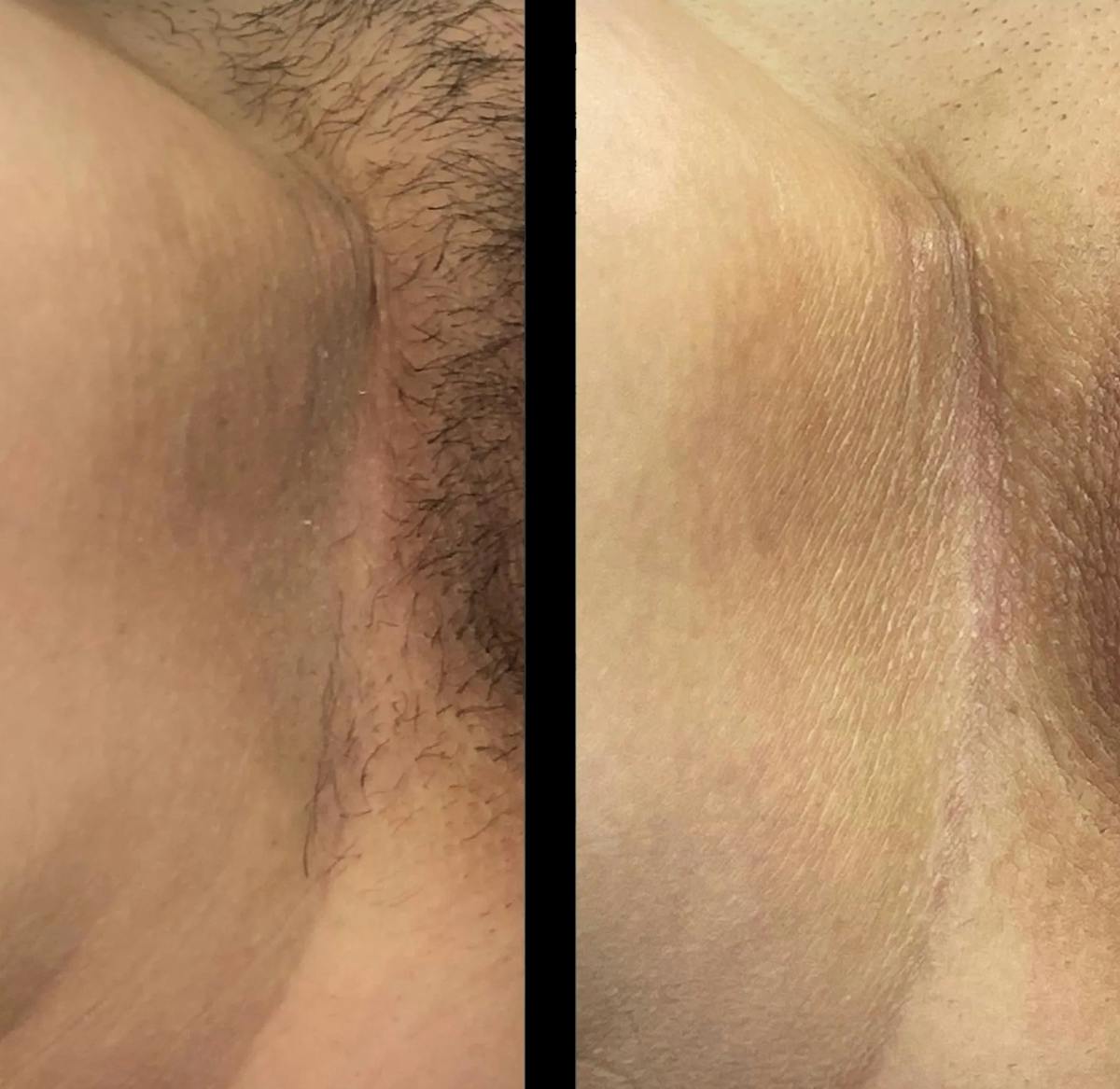 Intimate Skin Lightening Before & After Gallery - Patient 551062 - Image 1