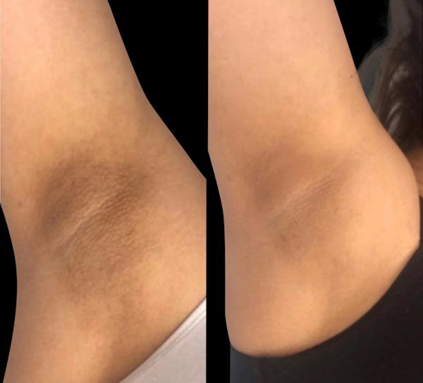 Intimate Skin Lightening Before & After Gallery - Patient 191245 - Image 1