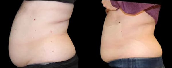 Muscle Building Before & After Gallery - Patient 775974 - Image 1