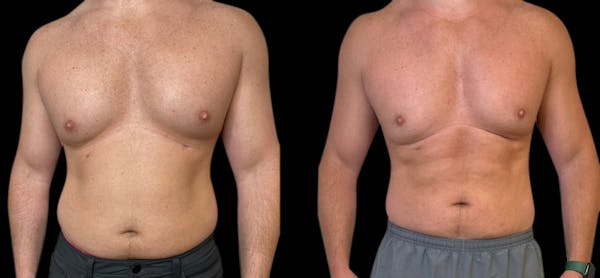 Muscle Building Before & After Gallery - Patient 347857 - Image 1